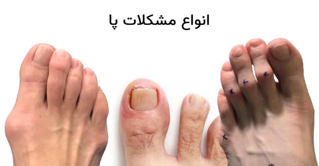 انواع مشکلات پا
