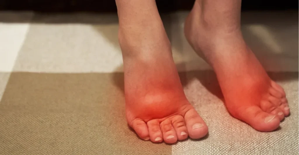 تورم پا بر اثر کفش تنگ