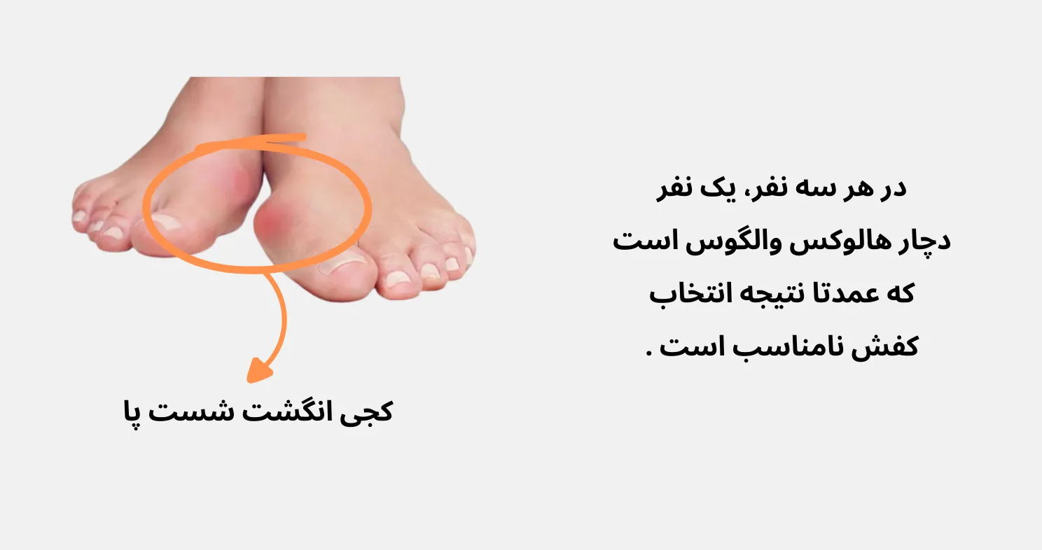 هالوکس والگوس شایع ترین بیماری پا