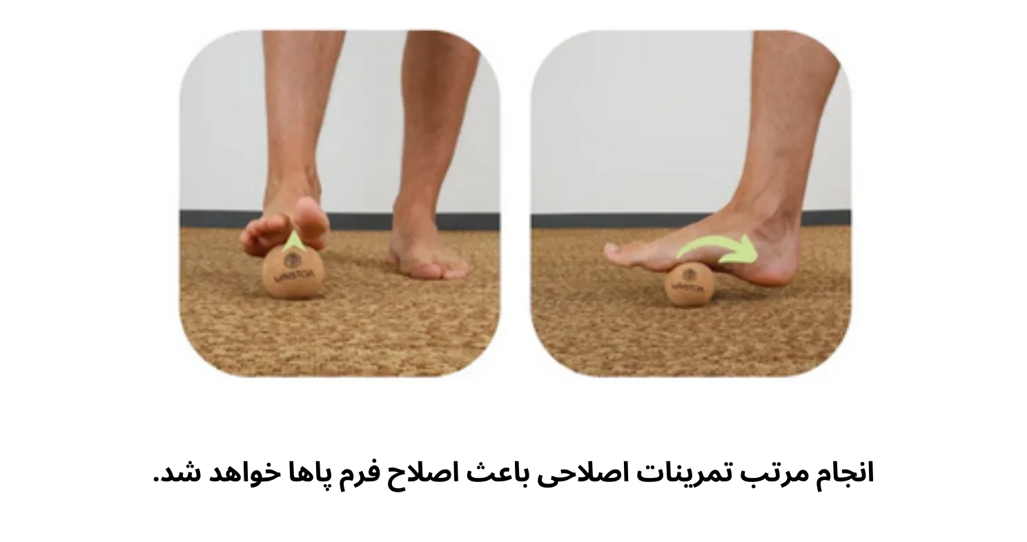 ورزش مخصوص هالوکس والگوس