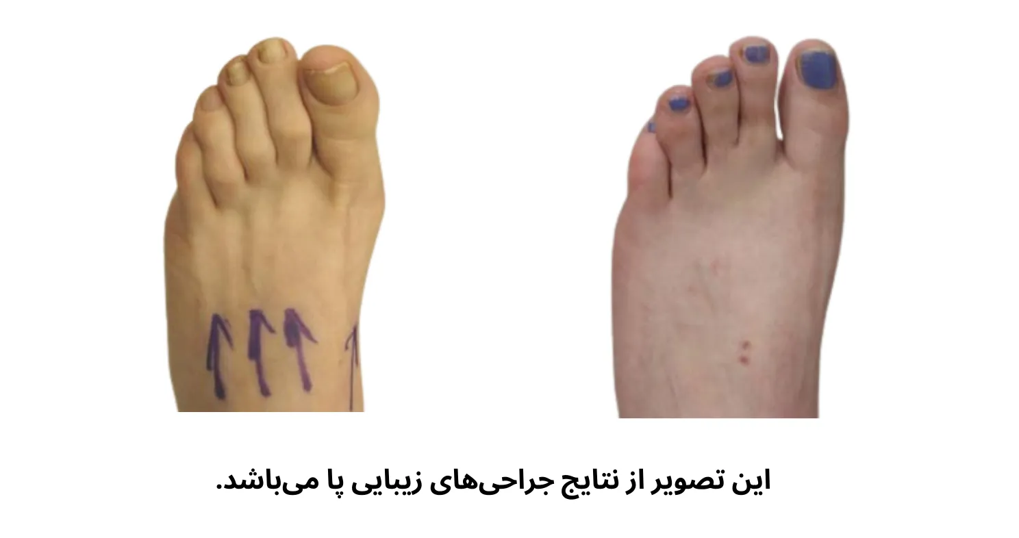 جراحی پا برای کاهش سایز کفش