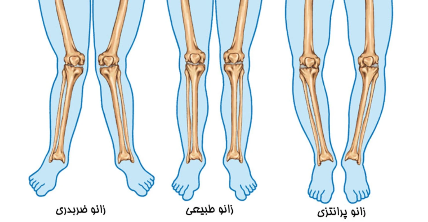 پای پرانتزی چیست