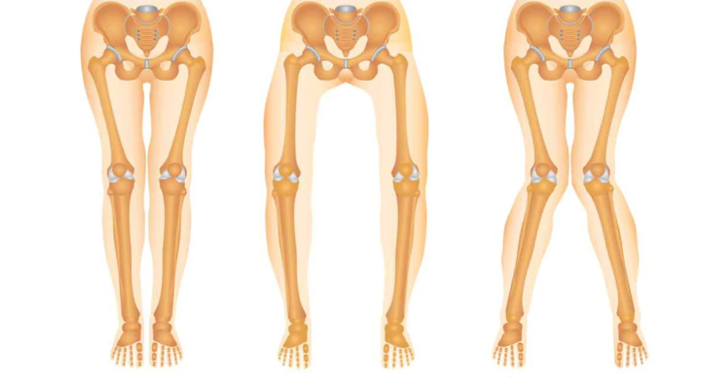 انتخاب بهترین کفش مناسب برای پای پرانتزی