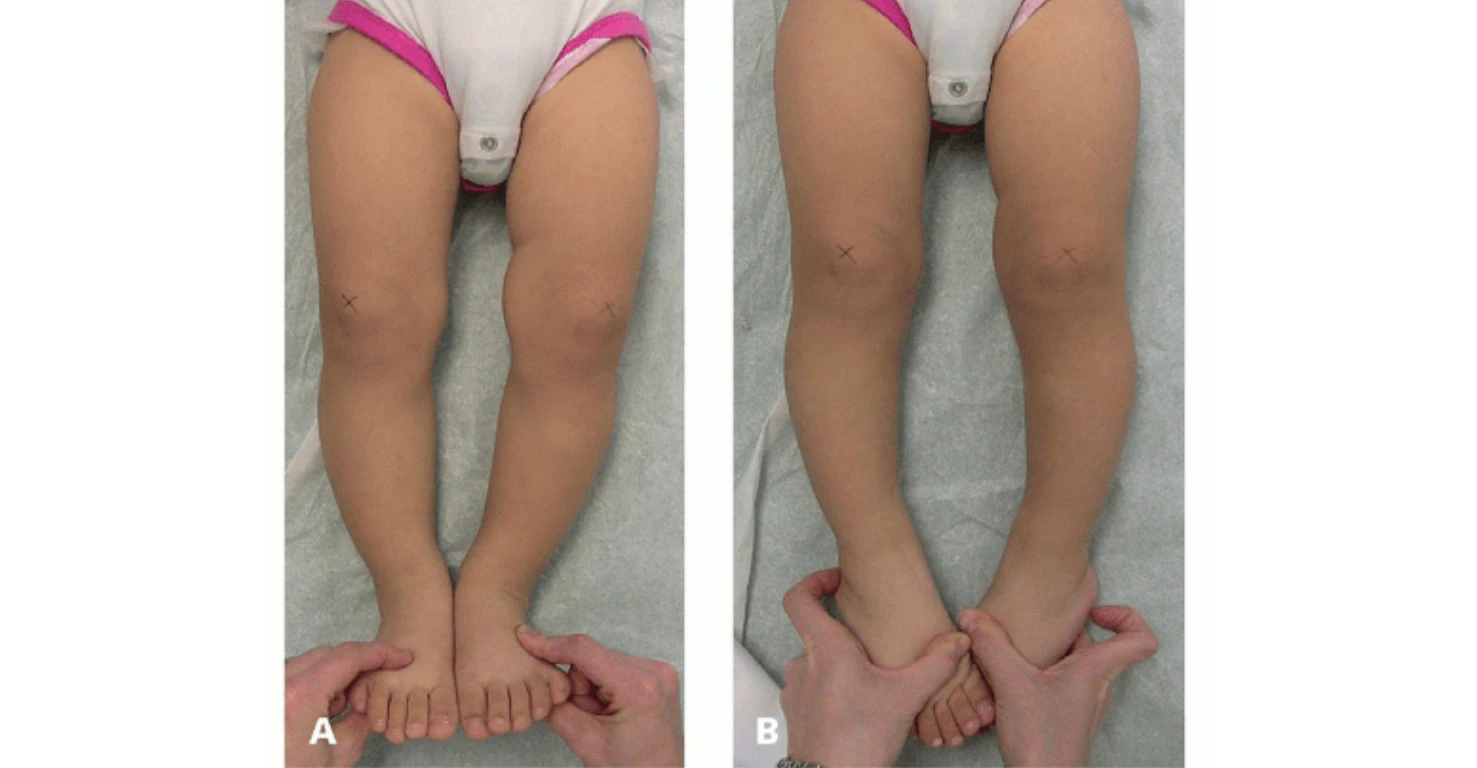 کفش مناسب برای کودکان با پای پرانتزی